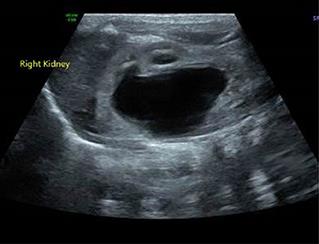 Congenital Mid Ureteric Valve Stenosis Revisited: Case Report and Review of the Literature